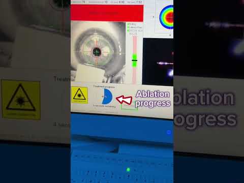 How fast is the excimer laser?